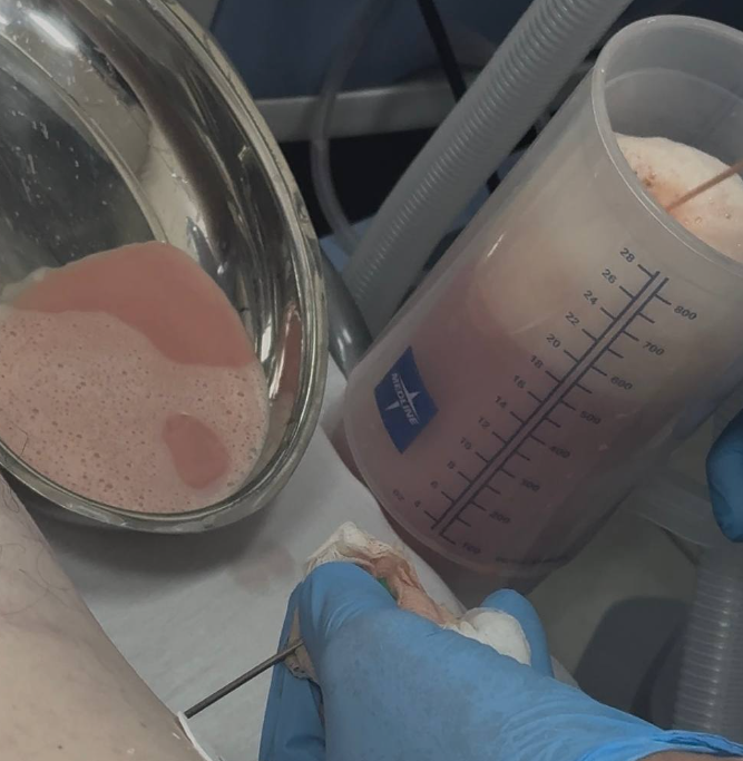 В Івано-Франківську медики врятували пацієнта з рідкісним розривом грудного лімфатичного протоку